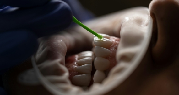 Dental implant care basics: Single-tooth replacement