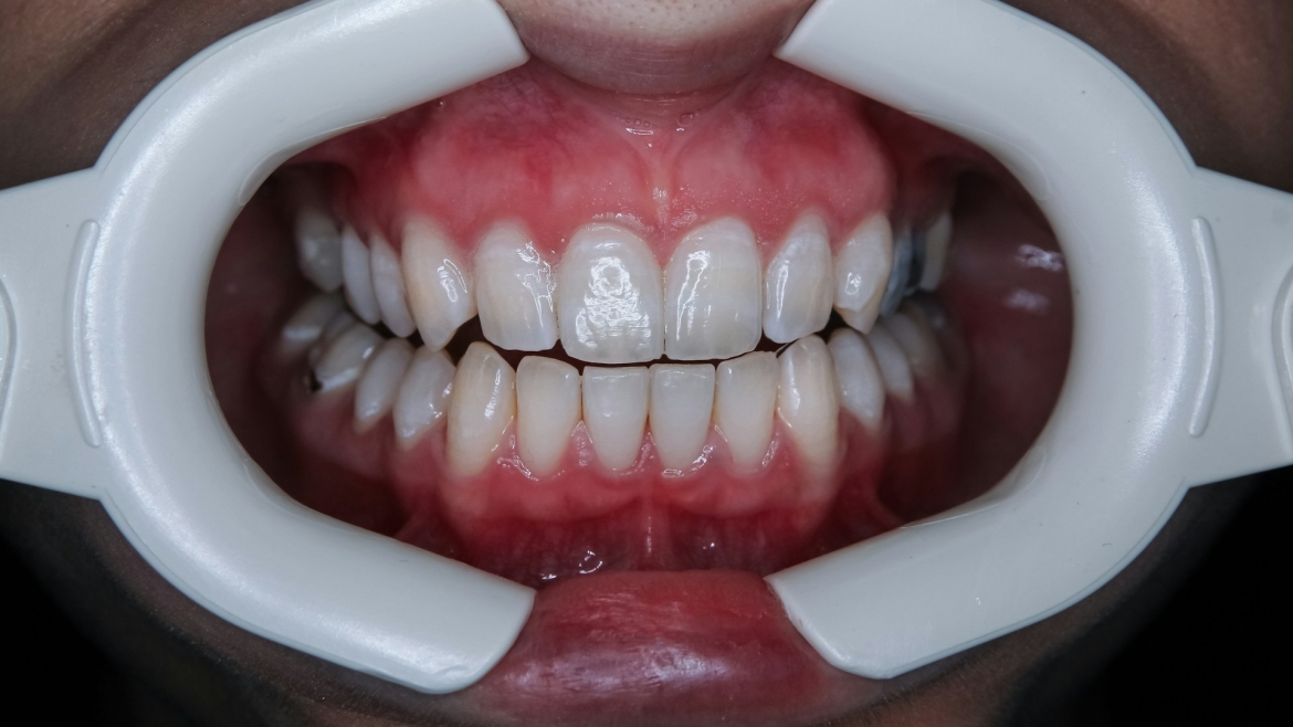 Teeth Whitening